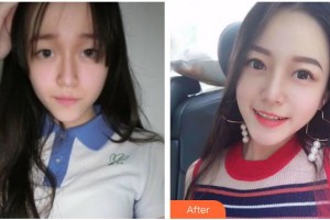 廣元朗睿整形美容醫(yī)院劉剛整形價(jià)格表附切開雙眼皮案例展示