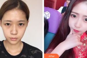 深圳黛顏醫(yī)療美容醫(yī)院李康整形價格表附眼部綜合案例展示