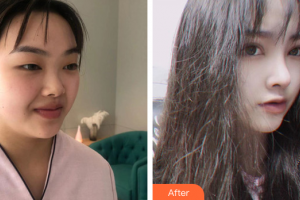 深圳建安醫(yī)療美容門診部李天石整形價(jià)格表附眼部手術(shù)+鼻部綜合案例展示