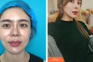 深圳建安醫(yī)療美容門診部羅君整形價格表附眼部綜合案例展示