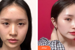 深圳香蜜麗格醫(yī)療美容門診部黎京雄整形價(jià)格表附眼部綜合案例展示