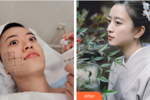 深圳星妍醫(yī)療美容診所宋月華整形價(jià)格表附熱瑪吉案例展示