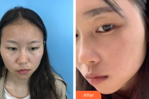 深圳星妍醫(yī)療美容診所廖祥龍整形價(jià)格表附祛痣案例展示