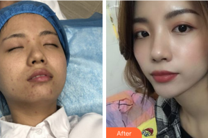 深圳悅她醫(yī)療美容診所沈洪波整形價(jià)格表附微針美塑案例展示