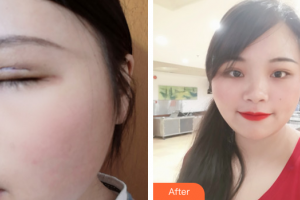 深圳詩(shī)蕾醫(yī)療美容診所劉遷整形價(jià)格表附切開雙眼皮案例展示