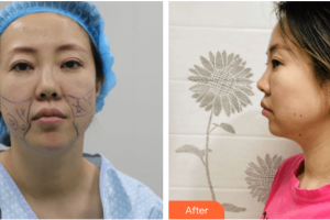 深圳悅她醫(yī)療美容診所張赫整形價(jià)格表附埋線提升案例展示