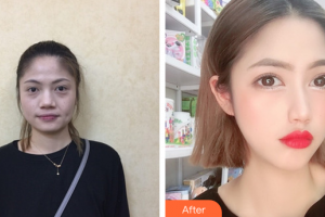 深圳格美醫(yī)療美容診所李英整形價(jià)格表附埋線提升案例展示