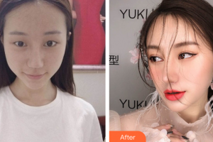 深圳陽(yáng)光整形美容醫(yī)院王勇整形價(jià)格表附眼部綜合案例展示