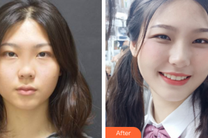 深圳陽(yáng)光整形美容醫(yī)院陳星光整形價(jià)格表附鼻部多項(xiàng)案例展示