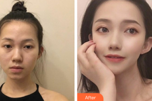 深圳陽(yáng)光整形美容醫(yī)院湯躍明整形價(jià)格表附假體隆鼻案例展示