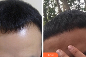 深圳陽(yáng)光整形美容醫(yī)院楊浩東整形價(jià)格表附種植發(fā)際線案例展示