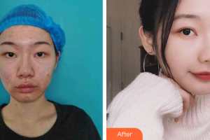 深圳美洛斯醫(yī)療美容診所張化博整形價(jià)格表附埋線雙眼皮案例展示