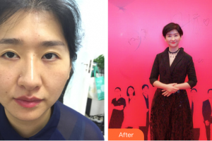 深圳陽(yáng)光整形美容醫(yī)院袁野整形價(jià)格表附雙眼皮修復(fù)案例展示