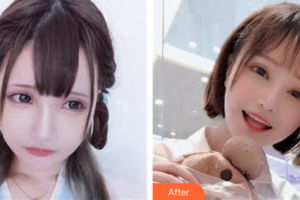 深圳麗格云發(fā)醫(yī)療美容診所劉志杰整形價(jià)格表附植發(fā)-種植發(fā)際線案例展示