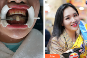 深圳松鼠悅上口腔門診部于麗軍整形價(jià)格表附牙齒美白案例展示