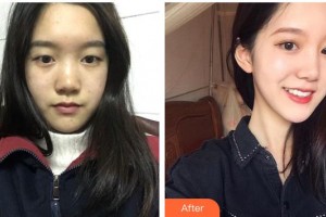 廣元市中心醫(yī)院眼科胡明祥整形價(jià)格表附眼部綜合案例展示