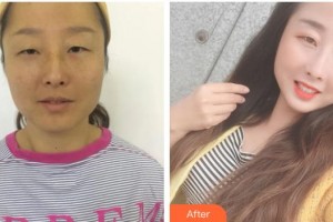 廣元市中心醫(yī)院眼科谷成勝整形價(jià)格表附內(nèi)切祛眼袋案例展示