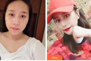 遂寧市康博醫(yī)學(xué)美容診所李紅梅整形價(jià)格表附肋軟骨隆鼻案例展示