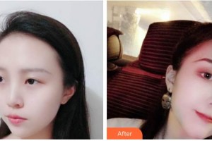 遂寧市中心醫(yī)院燒傷整形科侯勇整形價(jià)格表附鼻部綜合案例展示