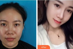 遂寧市中心醫(yī)院燒傷整形科徐敏住院醫(yī)師整形價(jià)格表附肋軟骨隆鼻案例展示