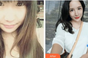 遂寧市中心醫(yī)院燒傷整形科白冰整形價(jià)格表附鼻部綜合案例展示