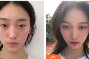 遂寧伊莎貝拉醫(yī)學(xué)美容門診部羅華整形價(jià)格表附眼部綜合案例展示