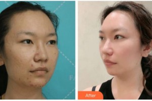 遂寧愛瑞陽(yáng)光眼科醫(yī)院整形價(jià)格表附切開雙眼皮案例展示