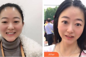 遂寧嘉慧口腔門診部整形價(jià)格表附牙齒隱形矯正案例展示