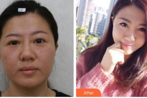 內(nèi)江市中醫(yī)醫(yī)院百合醫(yī)學(xué)美容中心張艷鋒整形價(jià)格表附埋線雙眼皮案例展示