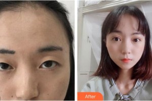 內(nèi)江市中醫(yī)醫(yī)院百合醫(yī)學(xué)美容中心李相君整形價(jià)格表附切開雙眼皮案例展示