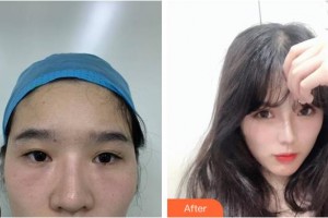 內(nèi)江百齡京菊醫(yī)療美容門診部龍卓宏整形價(jià)格表附眼部修復(fù)案例展示