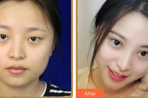 內(nèi)江百齡京菊醫(yī)療美容門診部徐勇整形價(jià)格表附眼部綜合案例展示