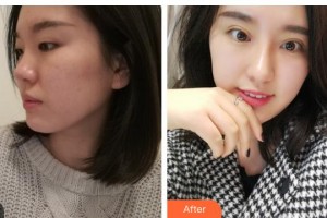 內(nèi)江百齡京菊醫(yī)療美容門診部劉培整形價(jià)格表附眼部綜合案例展示