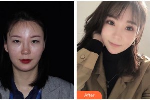 內(nèi)江百齡京菊醫(yī)療美容門診部李果整形價(jià)格表附眼部綜合案例展示