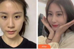 內(nèi)江百齡京菊醫(yī)療美容門診部文斌整形價(jià)格表附切開雙眼皮案例展示