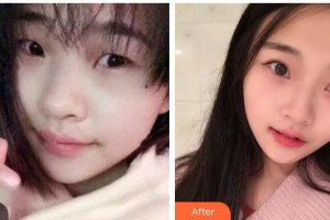 內(nèi)江百齡京菊醫(yī)療美容門診部謝肇菊整形價(jià)格表附切開雙眼皮案例展示