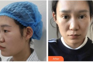 內(nèi)江瑞美醫(yī)療美容門診部楊娟整形價(jià)格表附眼部綜合案例展示