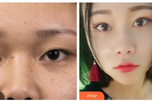 內(nèi)江瑞美醫(yī)療美容門診部羅冬鈴整形價(jià)格表附切開雙眼皮案例展示