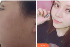 內(nèi)江瑞美醫(yī)療美容門診部金承俊整形價(jià)格表附眼部綜合案例展示