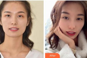 內(nèi)江華美口腔醫(yī)院剛整形價(jià)格表附牙齒隱形矯正案例展示