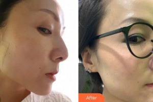 樂(lè)山金手指醫(yī)學(xué)美容診所羅秀平整形價(jià)格表附埋線提升案例展示