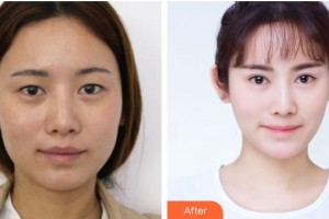 樂(lè)山市人民醫(yī)院燒傷整形外科賴運(yùn)泰整形價(jià)格表附眼部綜合案例展示