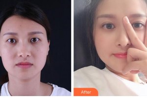 樂(lè)山美銳整形美容診所侯鵬整形價(jià)格表附眼部整形案例展示