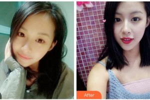 樂(lè)山王玉琨皮膚病專科醫(yī)院張麗整形價(jià)格表附眼部綜合案例展示