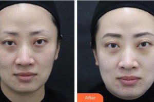 樂(lè)山王玉琨皮膚病?？漆t(yī)院王玉琨整形價(jià)格表附激光去眼袋案例展示