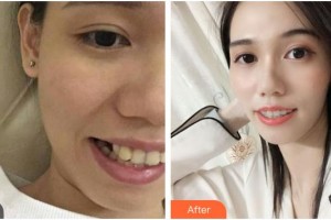 樂(lè)山英美口腔診所孫玉萍整形價(jià)格表附金屬托槽矯正案例展示