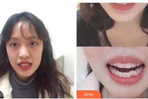 樂山口腔醫(yī)院龐洪整形價格表附牙齒隱形矯正案例展示