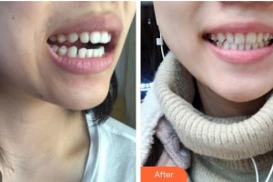 樂山口腔醫(yī)院張麗梅整形價格表附牙齒隱形矯正案例展示