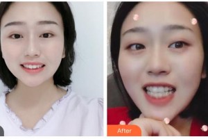 樂山口腔醫(yī)院汪培林整形價格表附牙齒隱形矯正案例展示