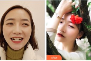 樂山口腔醫(yī)院何肖倩整形價格表附牙齒隱形矯正案例展示